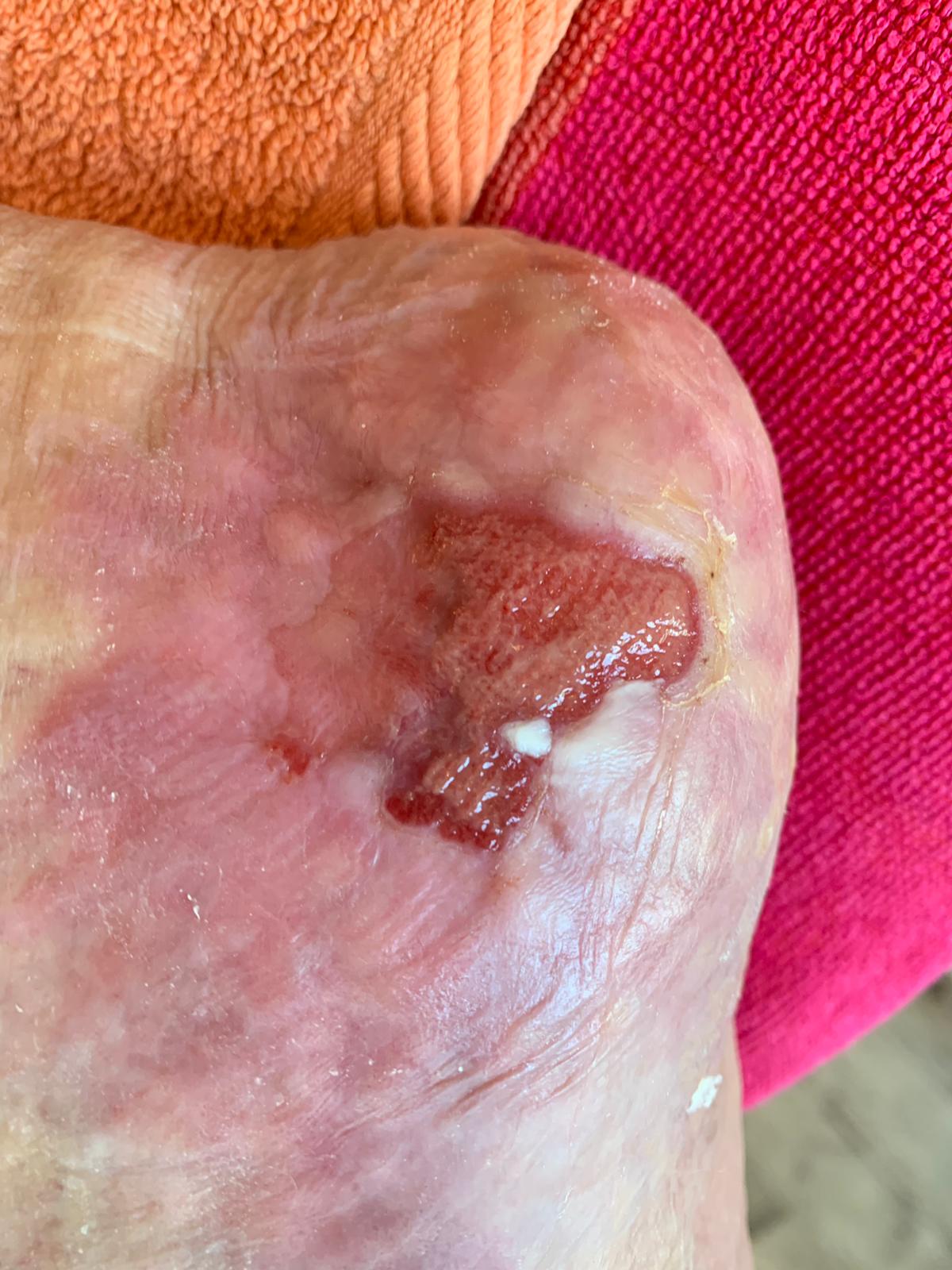 Venenkleber beim Offenen Bein Sealing veins in leg ulcers update