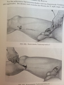 saphenbion-stripping 1957