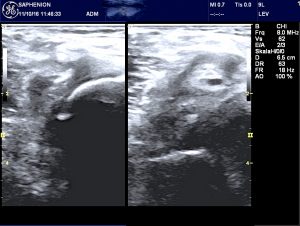 saphenion-bakers-cyst-after-sealing1