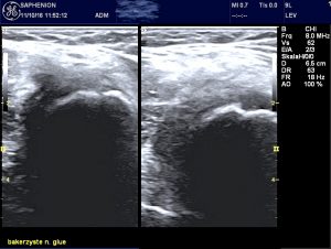 saphenion-bakers-cyst-after-sealing2