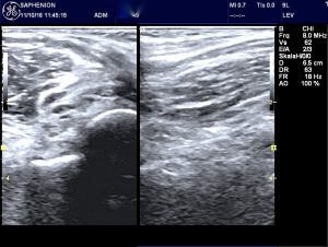 saphenion-bakers-cyst-catheter-inside