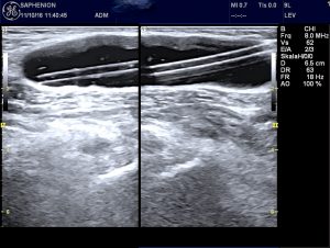 saphenion-bakerzyste-catheter-inside