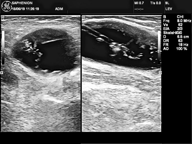 Wie Lange Dauert Es Bis Sich Eine Bakerzyste Zurückbildet Saphenion Protokoll Bakerzyste - Saphenion