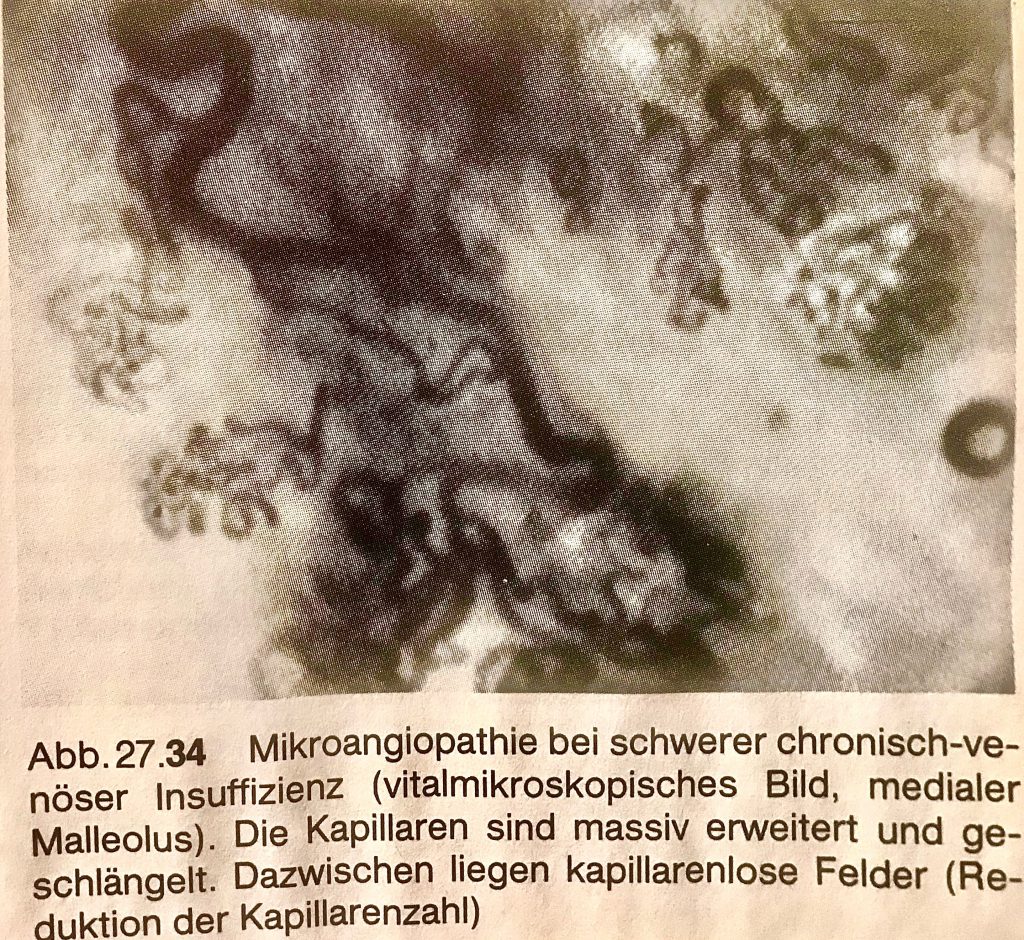 Dieses Bild hat ein leeres Alt-Attribut. Der Dateiname ist saphenion-dr.zierau-kapillarpathologie-bei-cvi-1024x940.jpg