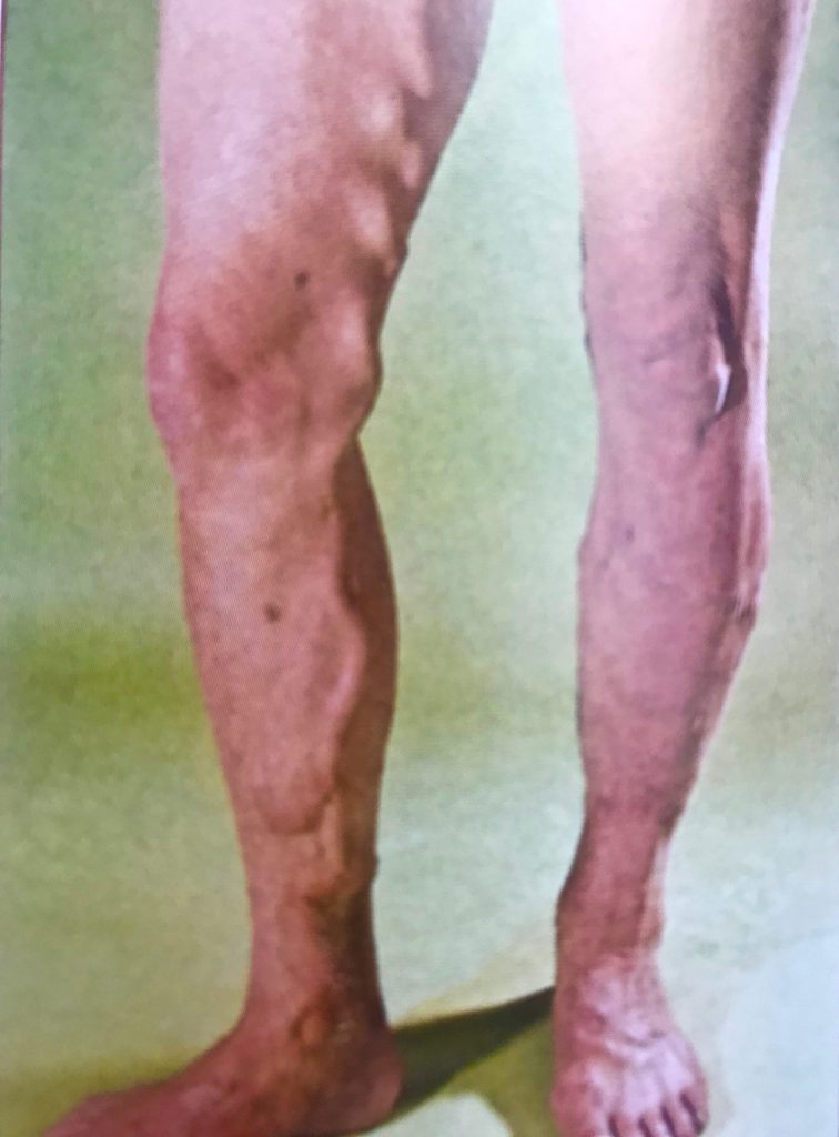 Dieses Bild hat ein leeres Alt-Attribut. Der Dateiname ist saphenion-dr.zierauklinisches-Bild-Venenerweiterunganeurysma-756x1024.jpg