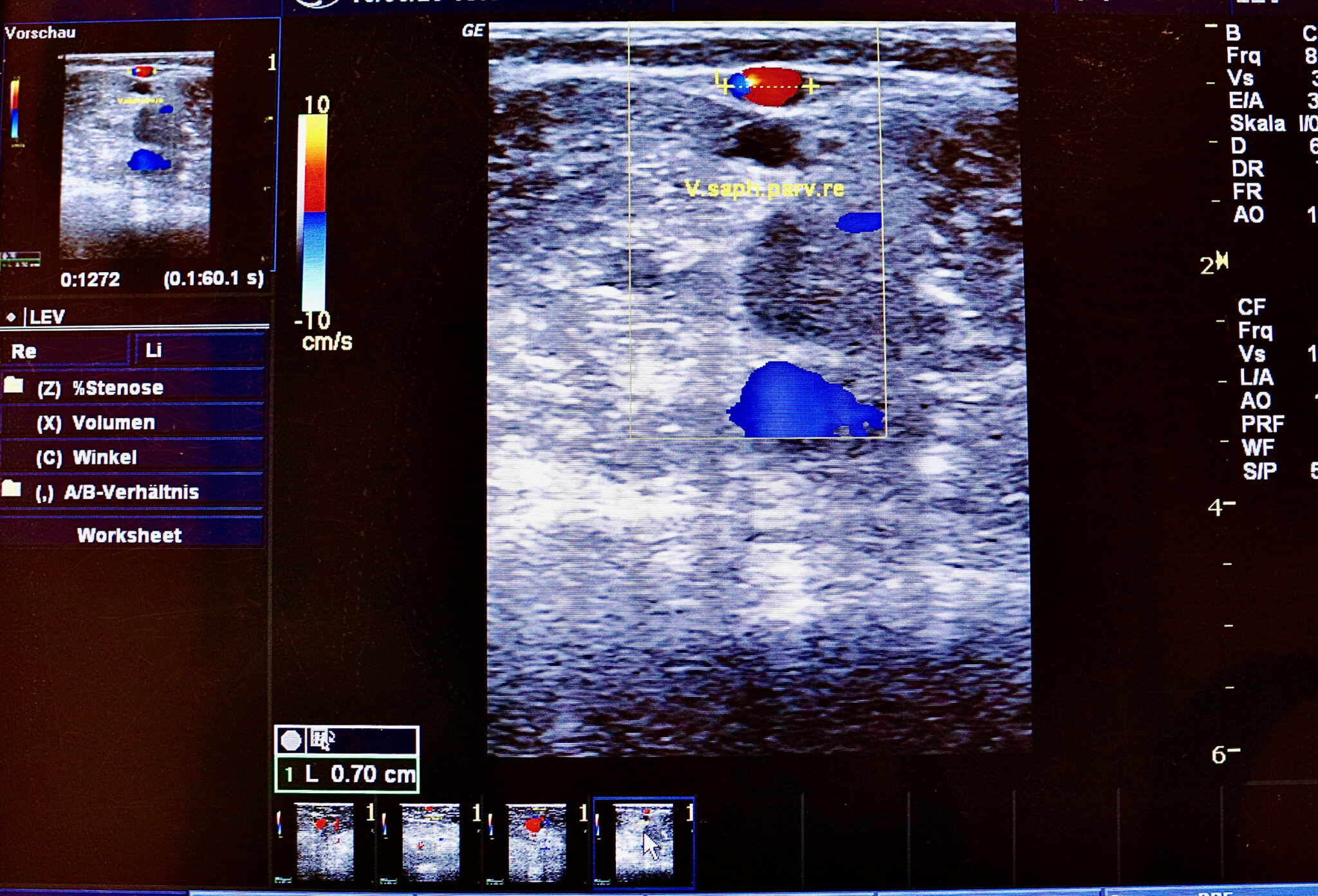 Saphenion® - Chronische Funktionsstörung der Beinvenen
