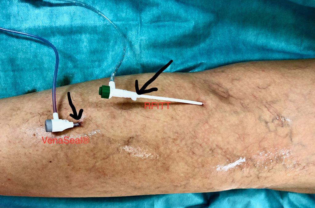 SAPHENION® - Moderne Venentherapie bei Dr.Zierau & Team.